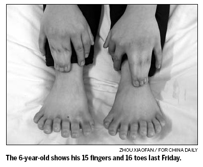 Doctors remove extra fingers, toes for 6-yr-old