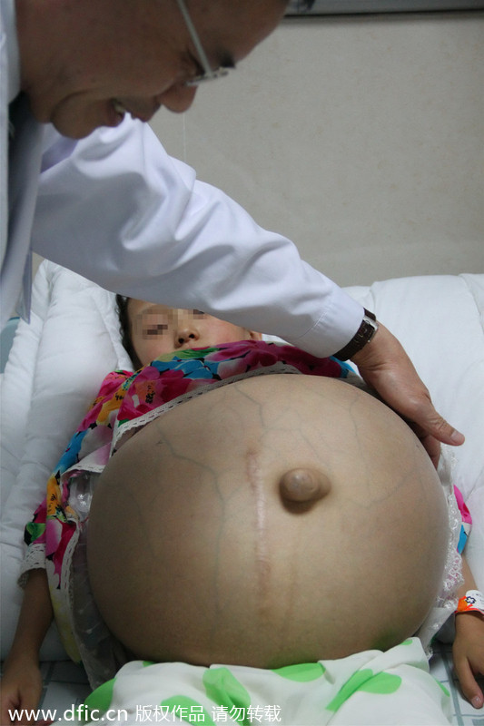 Guangzhou hospital offers hope to tumor girl