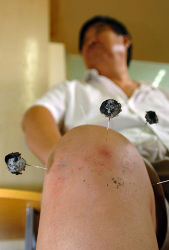 UNESCO bid for acupuncture sets off craze